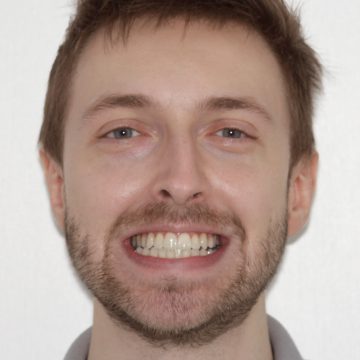 landing-page-default-2-after-360x360