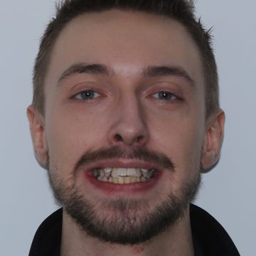 landing-page-default-2-before-360×360 landing-page-default-2-before-360x360